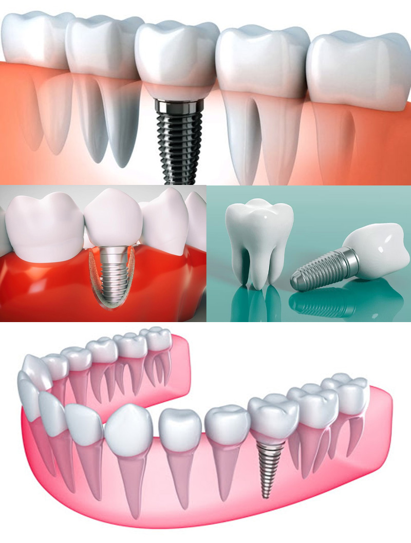 Implant