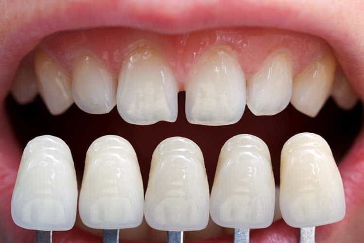 Laminated Teeth (Leaf Porcelain)